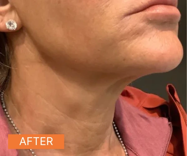 A sofwave after photo of a woman showing a more tighter skin under the chin.