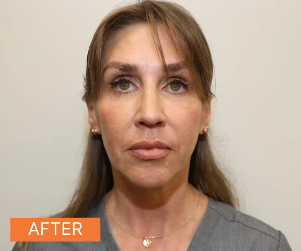 Sofwave after of a woman showing a more brighter and tighter skin.