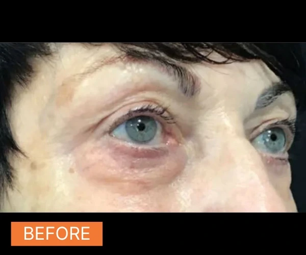Sofwave before photo of a woman's eye area.