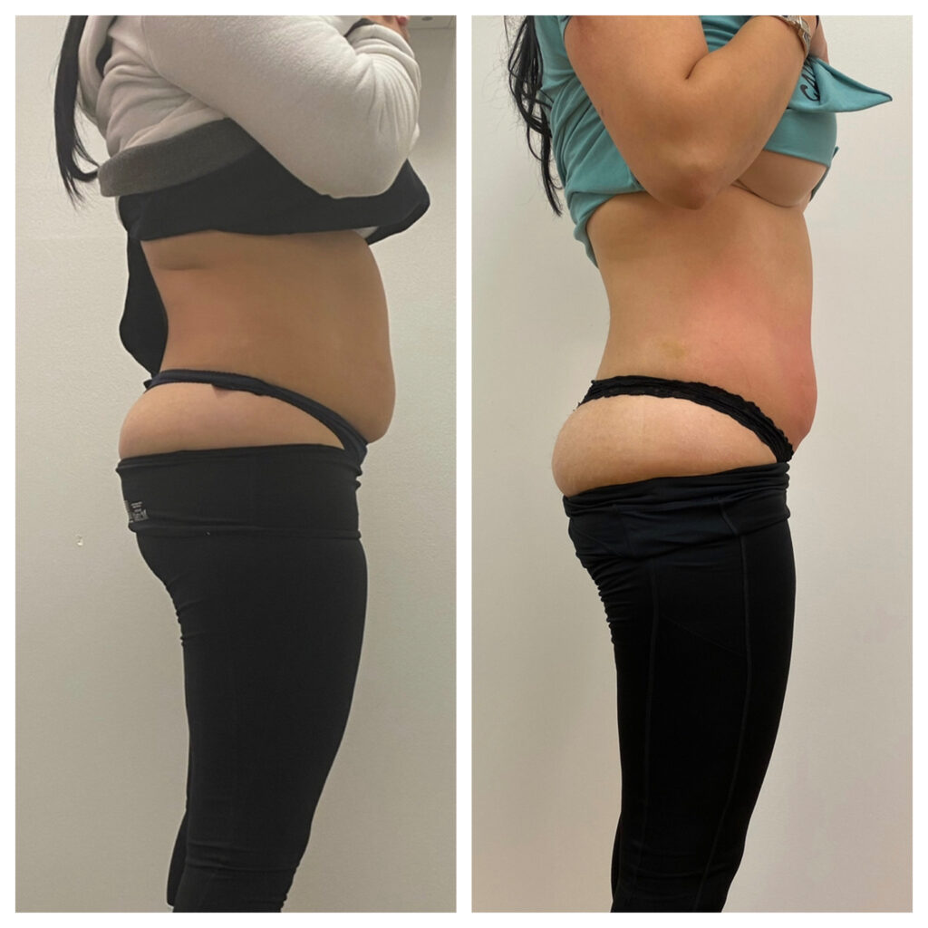 What is Emsculpt NEO, and how does it contour your body?