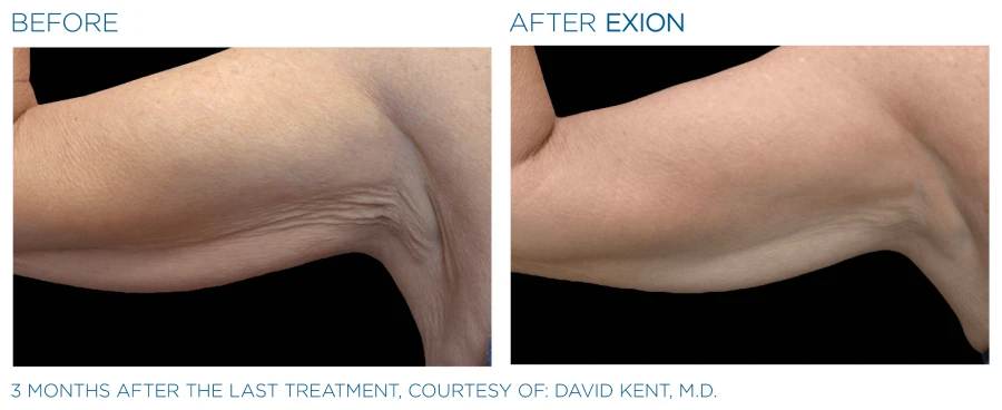 Before and after photos of a woman's tricep showing a tighter and firmer muscles (3 months after last treatment) from Exion Body treatments.
