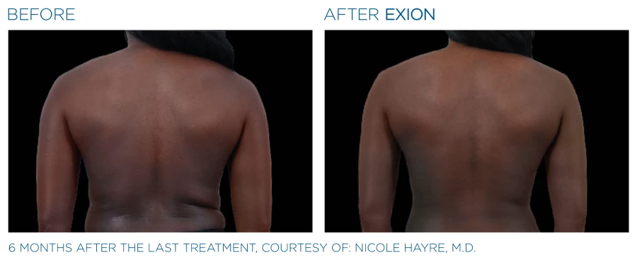 Before and after photos of back of a woman (6 months after last treatment) showing a reduced fat volume from Exion Body treatments.