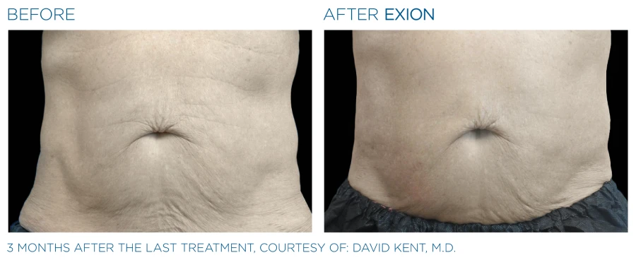 Before and after photos showing reduced wrinkles on a man's abdomen area (3 months after last treatment) from Exion Body treatments.