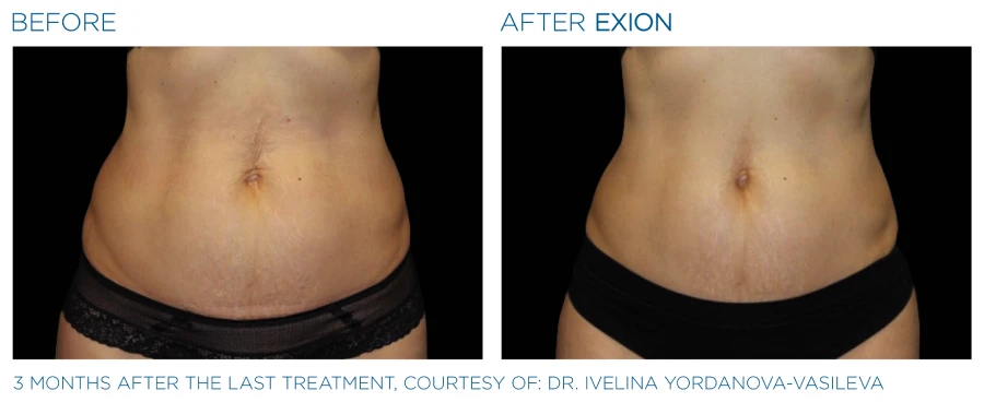 Before and after photos showing a reduced volume in a woman's abdomen (3 months after last treatment) from Exion Body treatments.