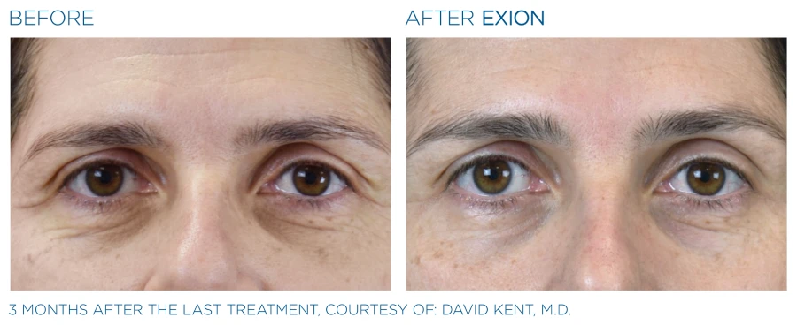 Before and after photos of Exion face treatment (3 months after last treatment) showing a reduced wrinkles on a woman's face.