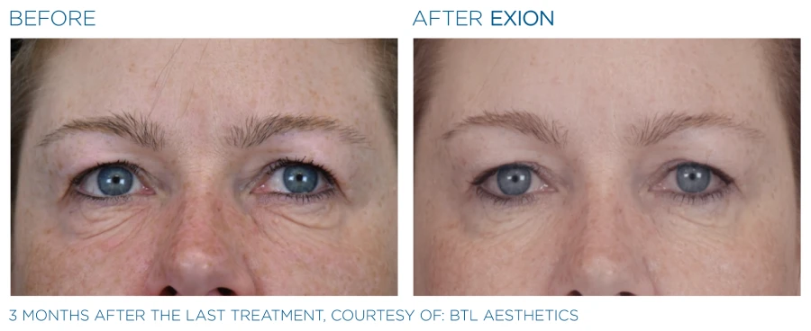 Before and after photos of a woman's face (3 months after last treatment) resulting to a younger complexion from Exion Face treatment.