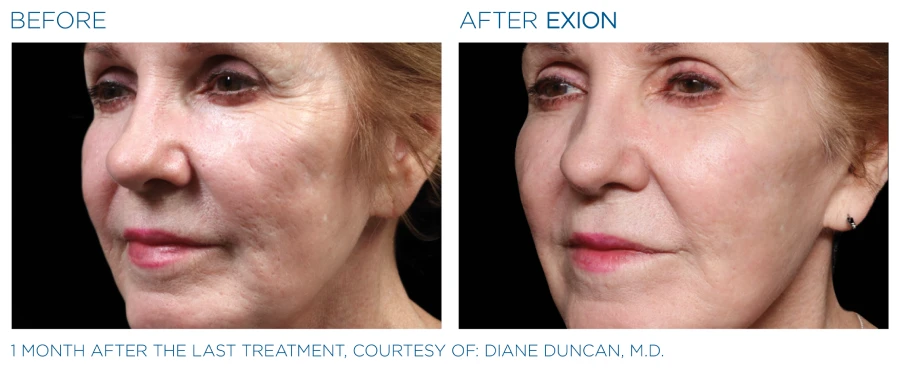 Before and after photos of a woman's face (1 month after last treatment) resulting in a younger and brighter skin.