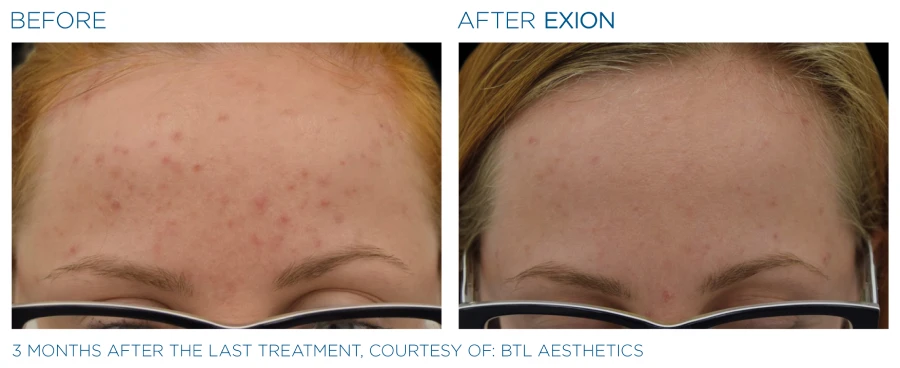 Before and after photos of Exion Face treatment (3 months after last treatment) resulting in a clearer and brighter skin.