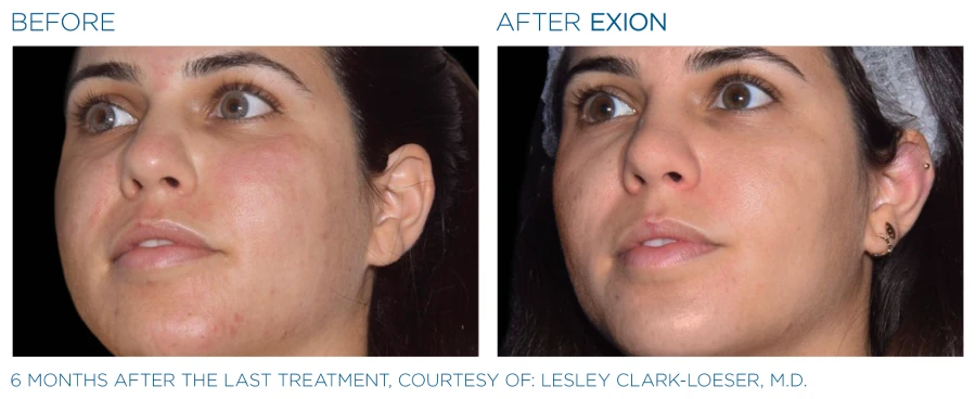 Before and after photos of an Exion face treatments (6 months after last treatment) showing a brighter and younger complexion.