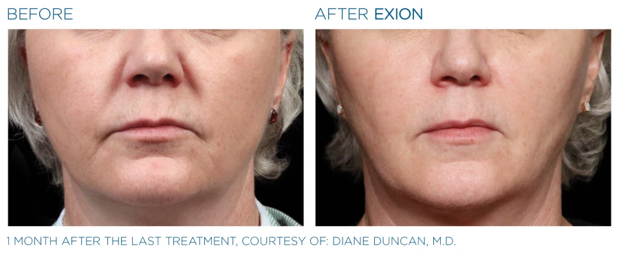 Before and after photos of a woman's face (1 month after last treatment) resulting in tighter skin from Exion face treatment.