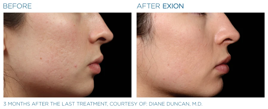 Before and after photos of sideview face of a woman, resulting to a clearer and younger skin from Exion microneedling.