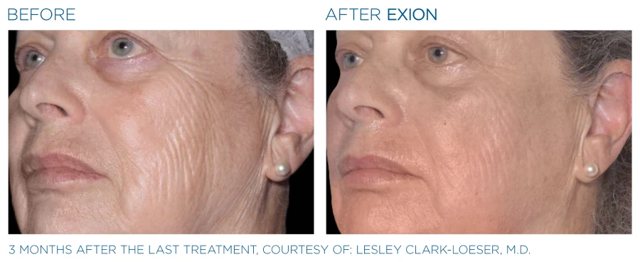 Before and after photos of a woman's face showing a reduced wrinkles from Exion microneedling.