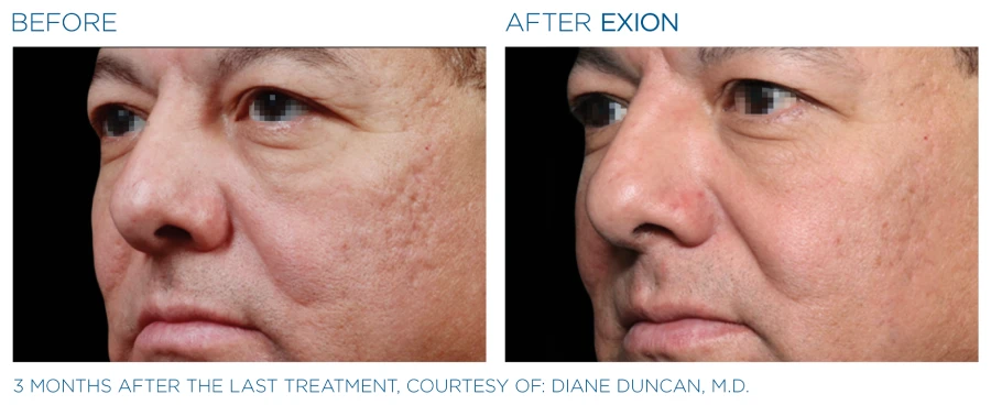 Before and after photos of a man's face resulting to a younger complexion from Exion Microneedling.